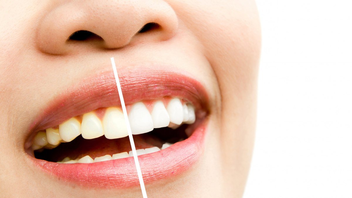 10 alimentos que devemos evitar após o clareamento dental