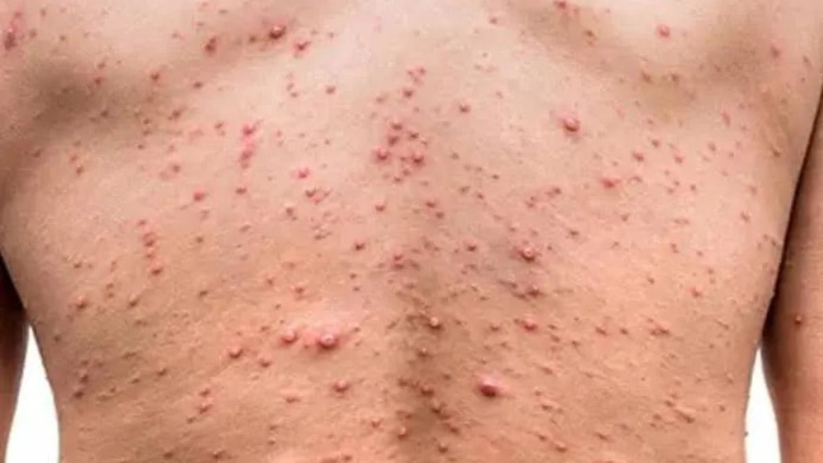OMS declara Mpox como emergência sanitária global, a primeira desde o coronavírus