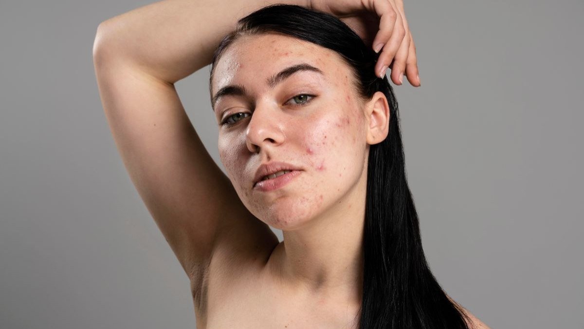 Por que a acne deixa cicatrizes?