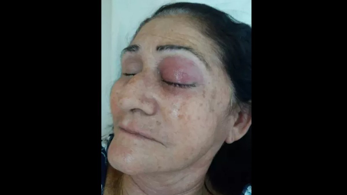 Cresce para nove o número de pessoas que perderam olho após mutirão de cirurgia