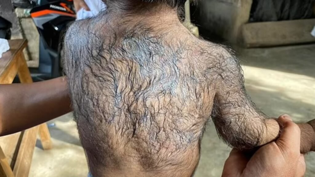 Bebês ficam ‘peludos’ após pais usarem famoso produto contra queda capilar; entenda