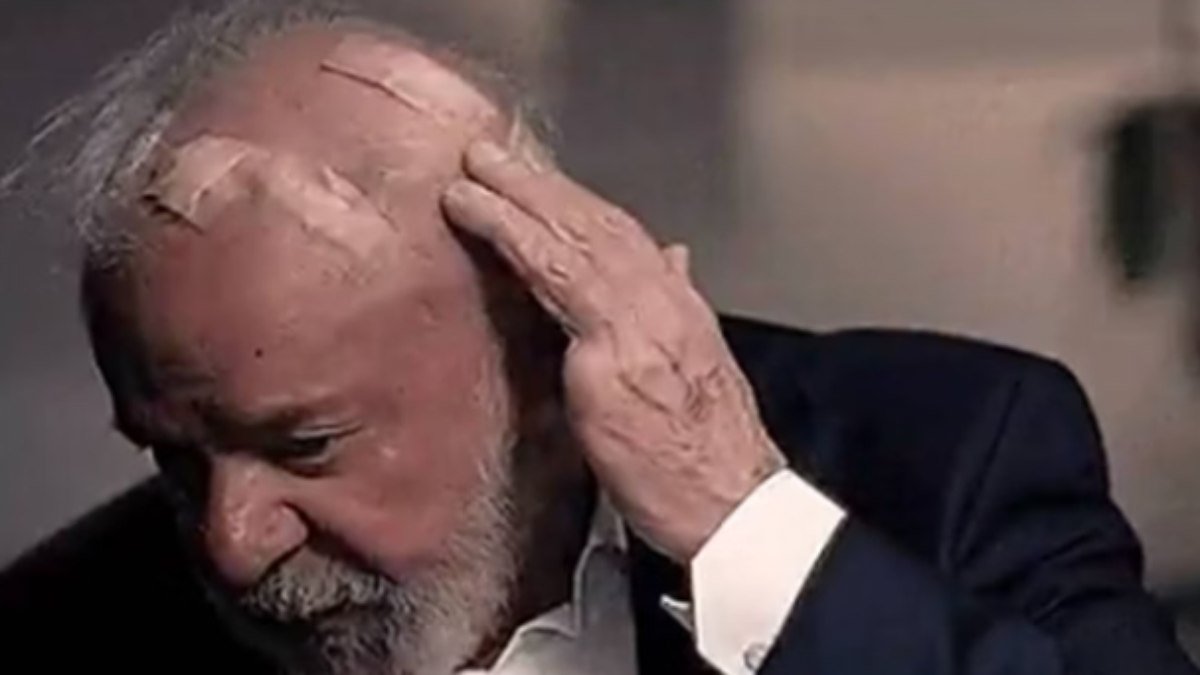 Lula relembra susto e mostra como ficou a cabeça após cirurgias de emergências em SP