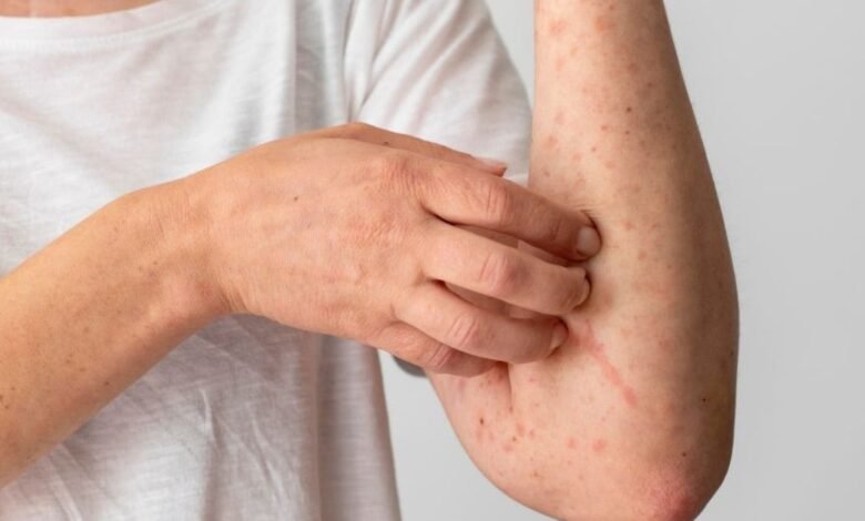 Casos de Herpes-Zóster no Brasil crescem; médicos explicam a doença Casos de Herpes-Zóster no Brasil crescem; médicos explicam a doença