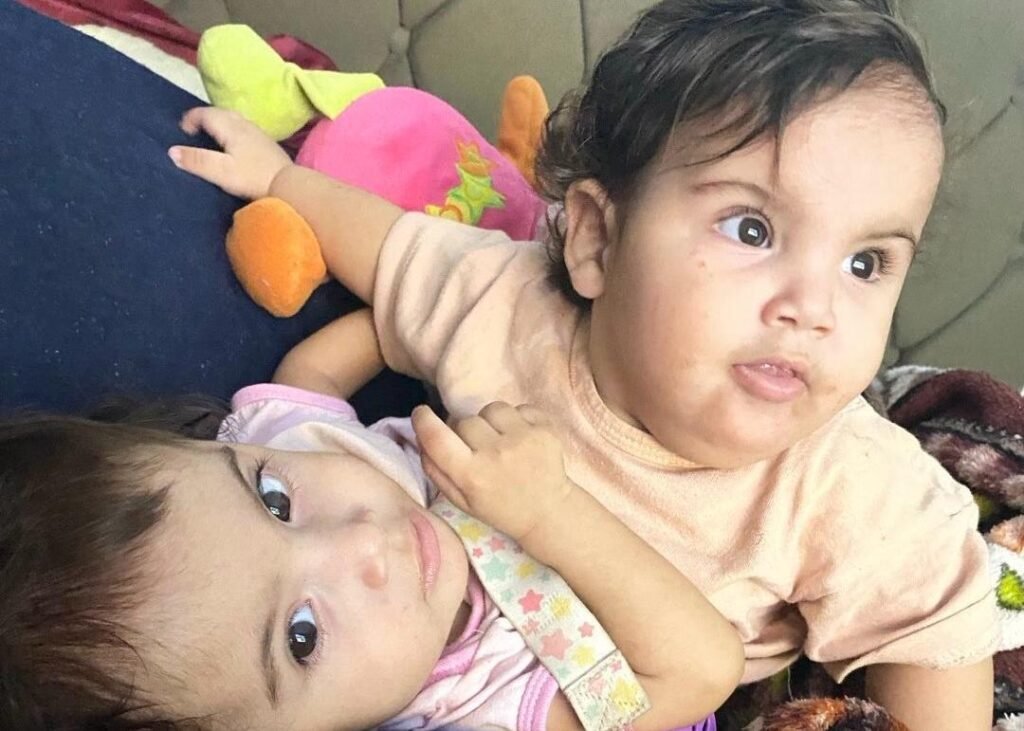 Irmã de siamesa que morreu após cirurgia continua internada