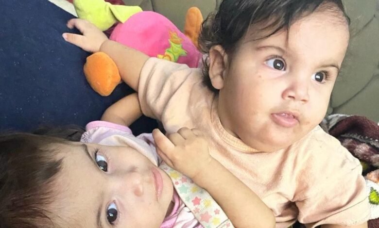 Irmã de siamesa que morreu após cirurgia continua internada Irmã de siamesa que morreu após cirurgia continua internada