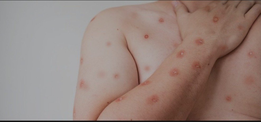 Saúde de Goiânia reforça orientações para casos de monkeypox