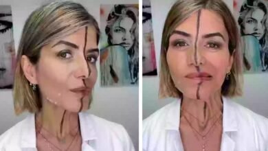 Médica aplica botox em apenas um lado do rosto para mostrar efeitos; veja