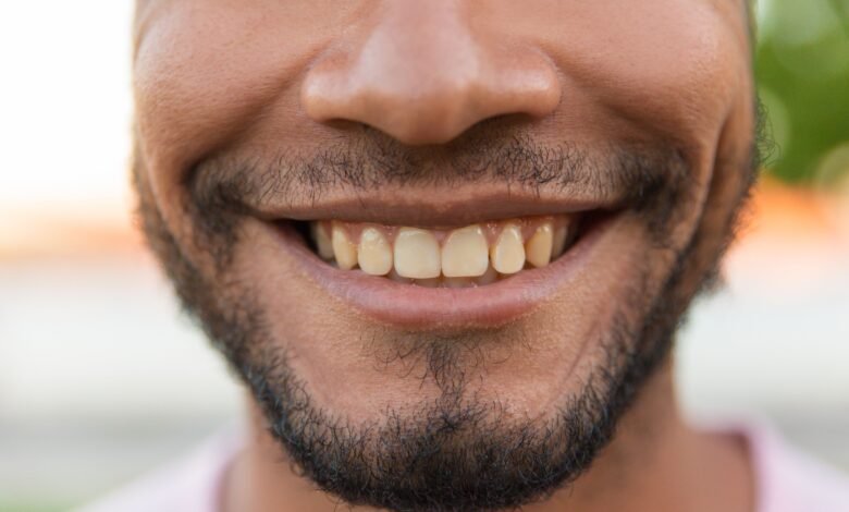 7 Alimentos e hábitos que escurecem os dentes 7 Alimentos e hábitos que escurecem os dentes
