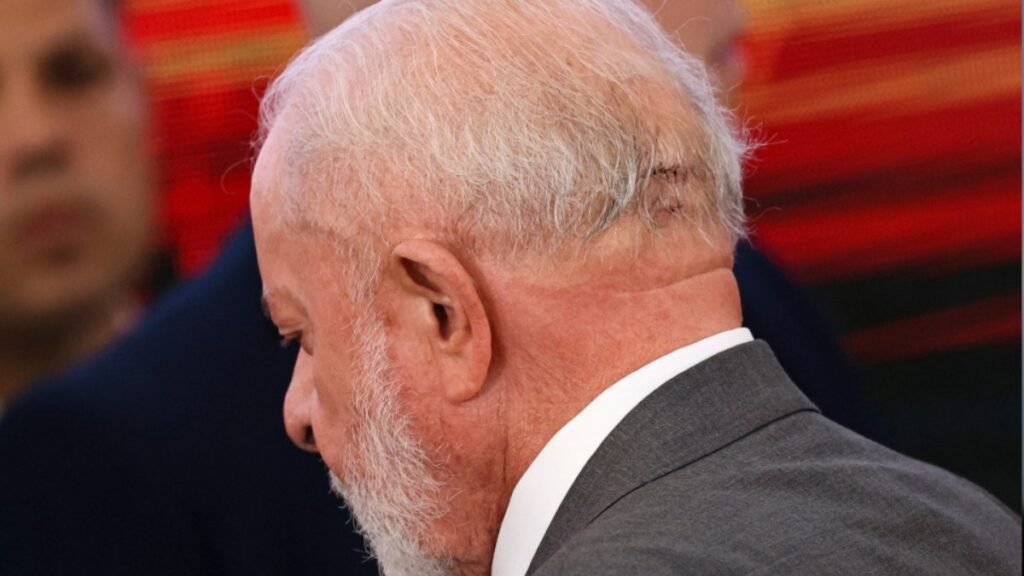 Lula passará por embolização; entenda o procedimento