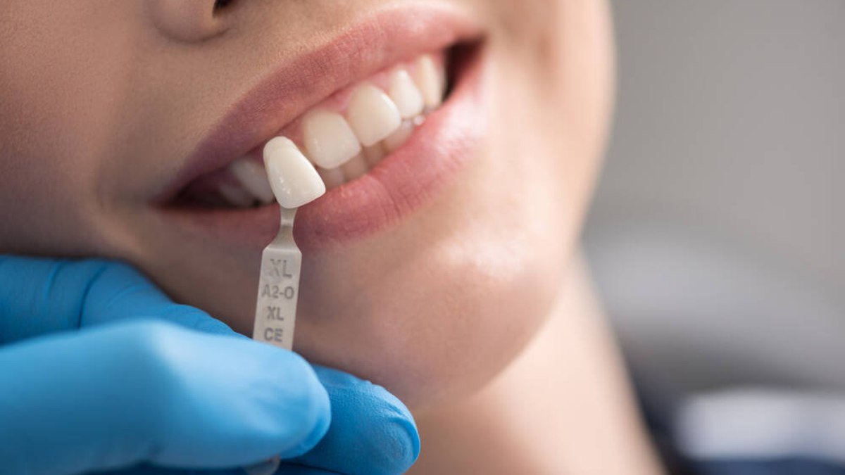 O que é levantamento do seio maxilar para colocação de implantes dentais O que é levantamento do seio maxilar para colocação de implantes dentais