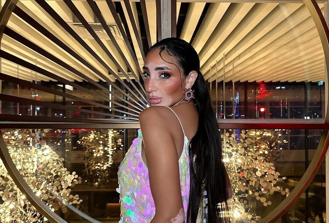 Miss Universo terá candidata com vitiligo pela primeira vez