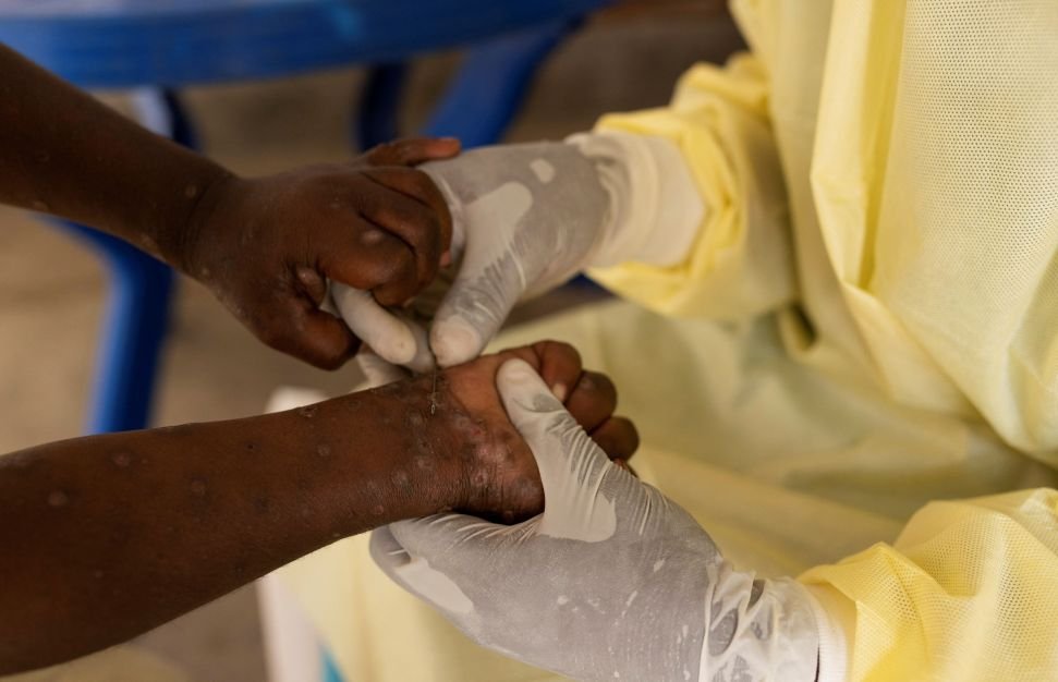 “Mpox não é a nova Covid“, diz diretor da Organização Mundial da Saúde