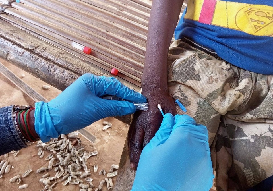OMS faz recomendações para situações de surto por mpox OMS faz recomendações para situações de surto por mpox